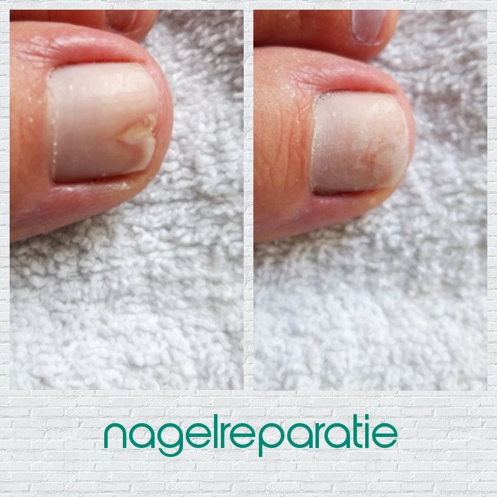 Nagelreparatie